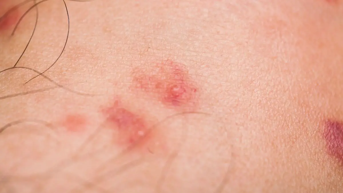 red flea bites